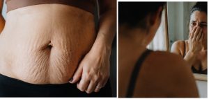 barriga colgona y con estrias post parto