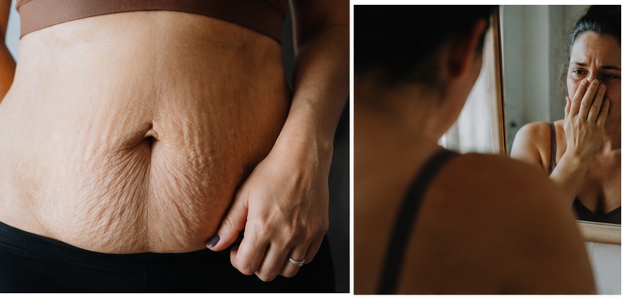 barriga colgona y con estrias post parto