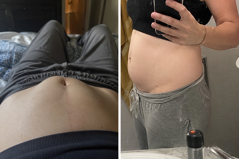 barriga en forma de cono